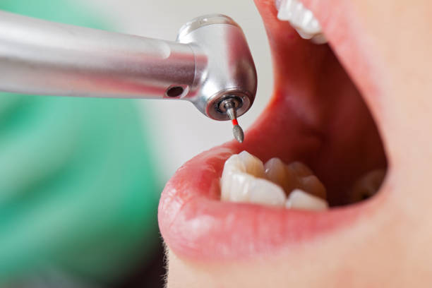 Best Urgent Care for Lost Fillings or Crowns in Oriska, NY
